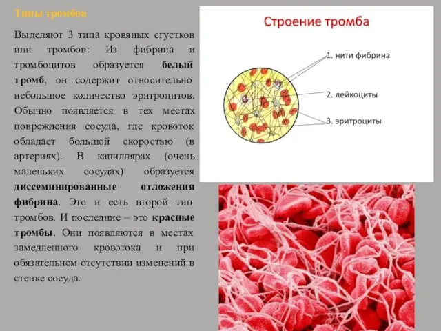 Типы тромбов Выделяют 3 типа кровяных сгустков или тромбов: Из