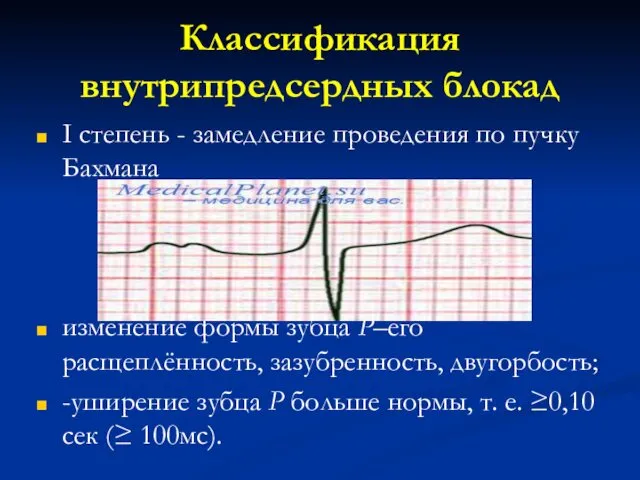 Классификация внутрипредсердных блокад I степень - замедление проведения по пучку