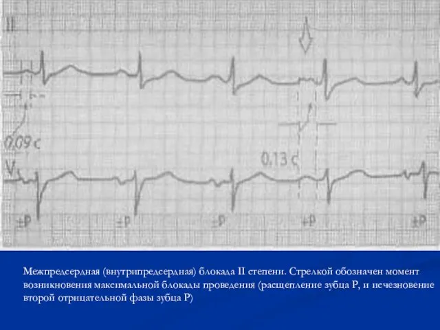 Межпредсердная (внутрипредсердная) блокада II степени. Стрелкой обозначен момент возникновения максимальной
