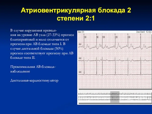 Атриовентрикулярная блокада 2 степени 2:1 В случае нарушения проведе- ния на уровне АВ