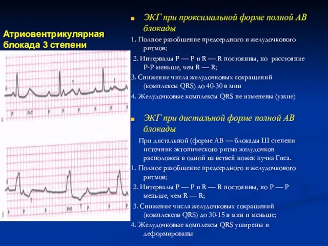 Атриовентрикулярная блокада 3 степени ЭКГ при проксимальной форме полной АВ