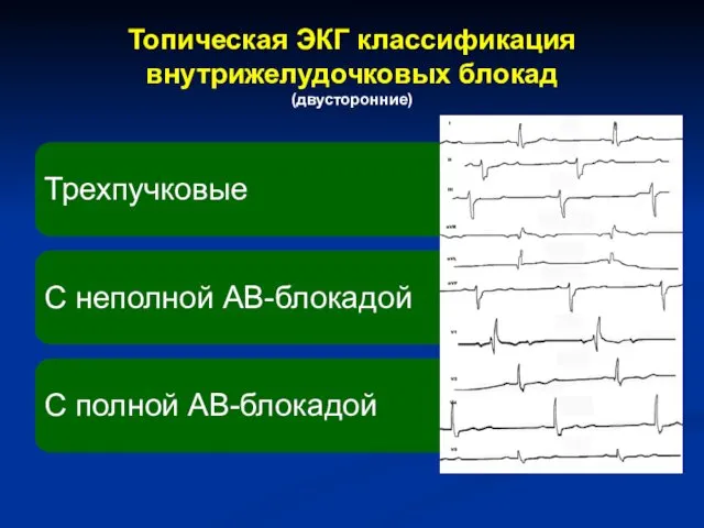 Топическая ЭКГ классификация внутрижелудочковых блокад (двусторонние)