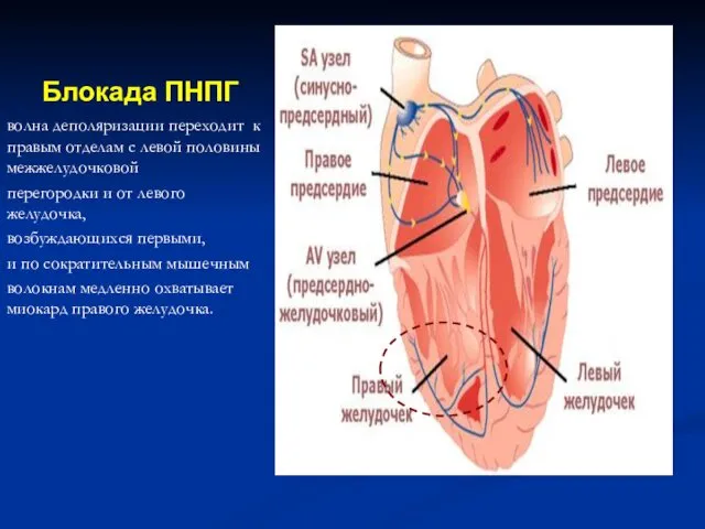 Блокада ПНПГ волна деполяризации переходит к правым отделам с левой