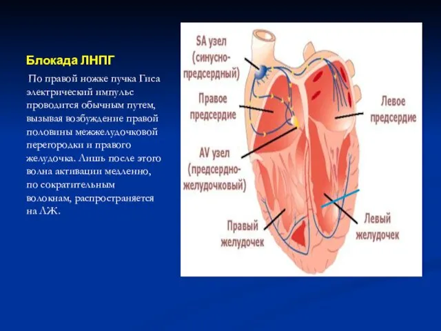 Блокада ЛНПГ По правой ножке пучка Гиса электрический импульс проводится