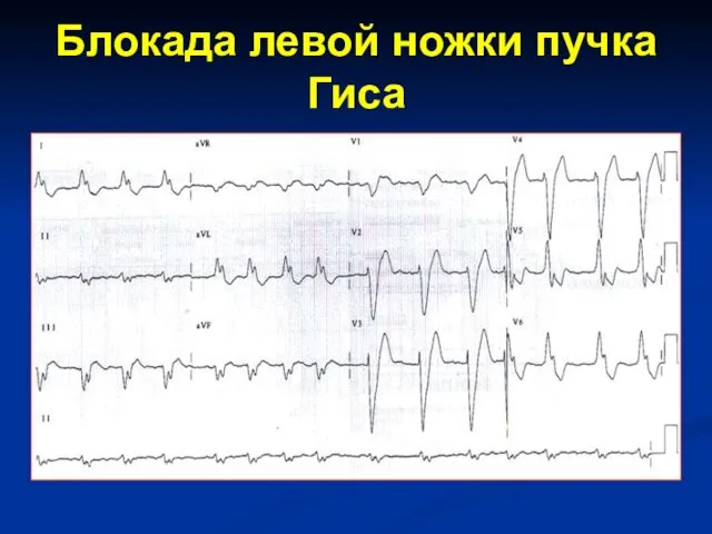 Блокада левой ножки пучка Гиса