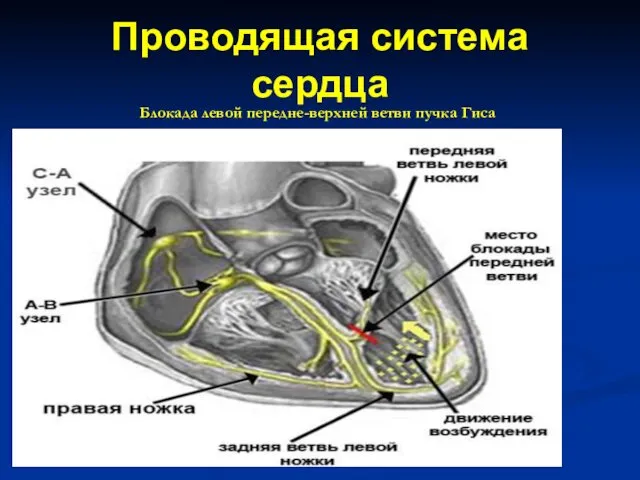 Проводящая система сердца Блокада левой передне-верхней ветви пучка Гиса