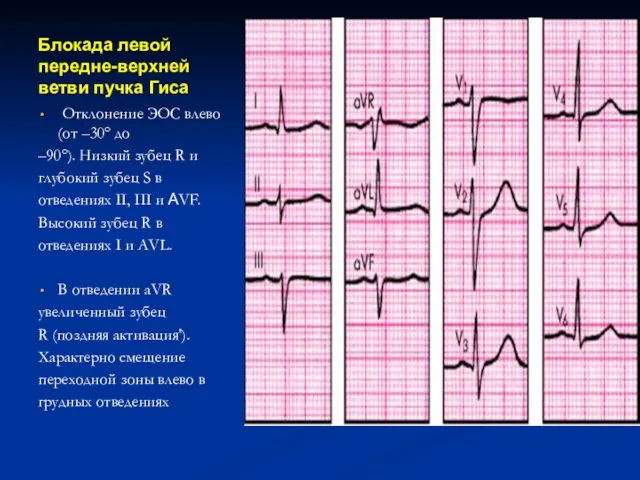 Блокада левой передне-верхней ветви пучка Гиса Отклонение ЭОС влево (от