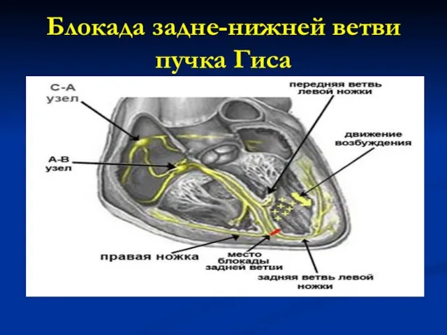 Блокада задне-нижней ветви пучка Гиса