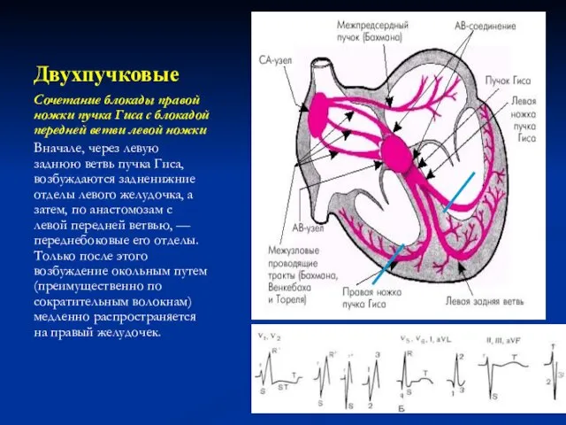 Двухпучковые Сочетание блокады правой ножки пучка Гиса с блокадой передней