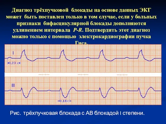 Диагноз трёхпучковой блокады на основе данных ЭКГ может быть поставлен