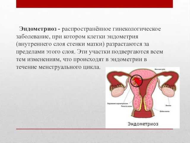 Эндометриоз - распространённое гинекологическое заболевание, при котором клетки эндометрия (внутреннего