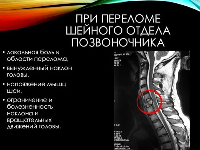 ПРИ ПЕРЕЛОМЕ ШЕЙНОГО ОТДЕЛА ПОЗВОНОЧНИКА локальная боль в области перелома,