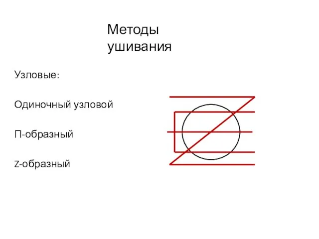 Узловые: Одиночный узловой П-образный Z-образный Методы ушивания