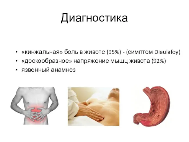 Диагностика «кинжальная» боль в животе (95%) - (симптом Dieulafoy) «доскообразное» напряжение мышц живота (92%) язвенный анамнез