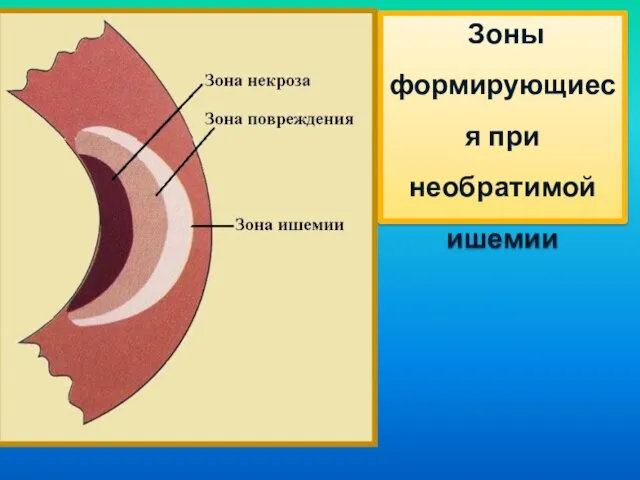 Зоны формирующиеся при необратимой ишемии