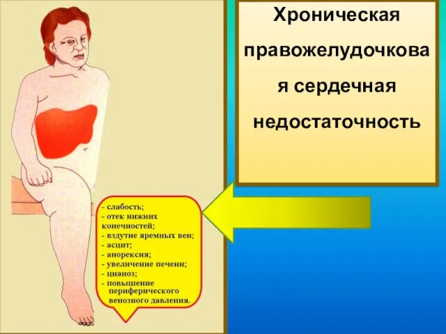 Хроническая правожелудочковая сердечная недостаточность