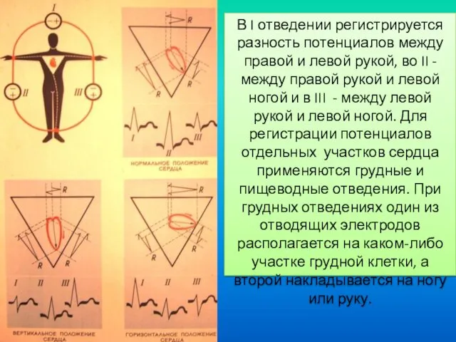 В I отведении регистрируется разность потенциалов между правой и левой