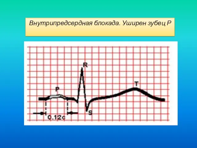 Внутрипредсердная блокада. Уширен зубец Р