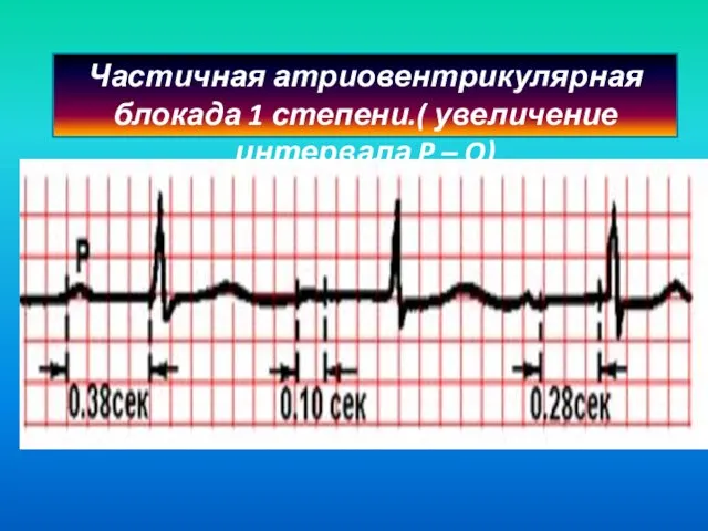 Частичная атриовентрикулярная блокада 1 степени.( увеличение интервала P – Q)