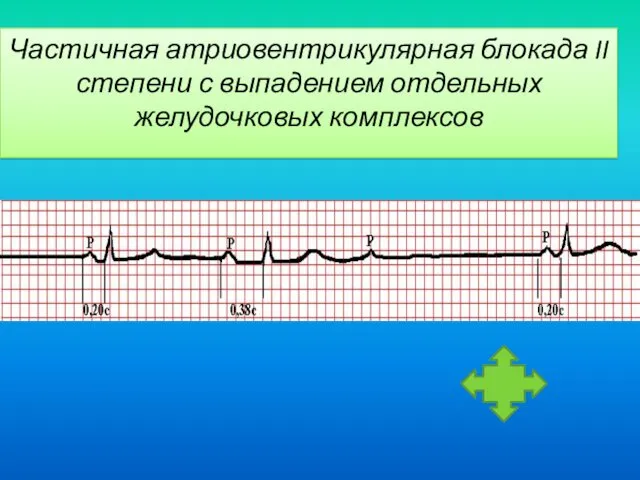 Частичная атриовентрикулярная блокада II степени с выпадением отдельных желудочковых комплексов