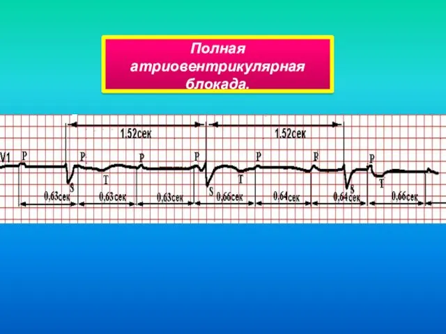 Полная атриовентрикулярная блокада.
