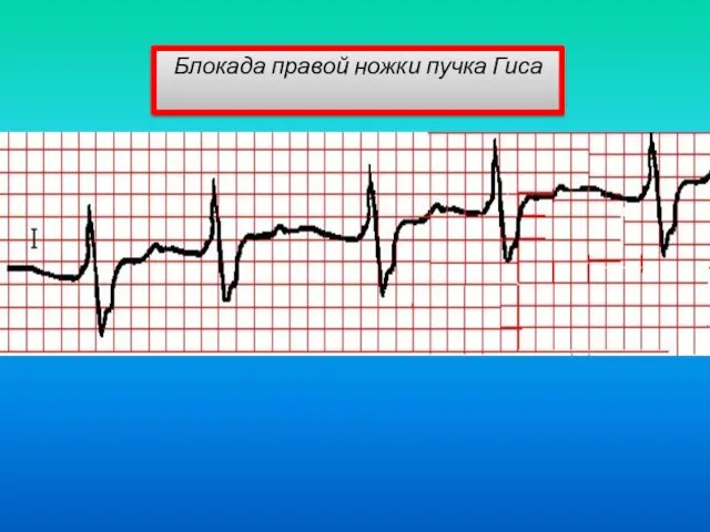 Блокада правой ножки пучка Гиса