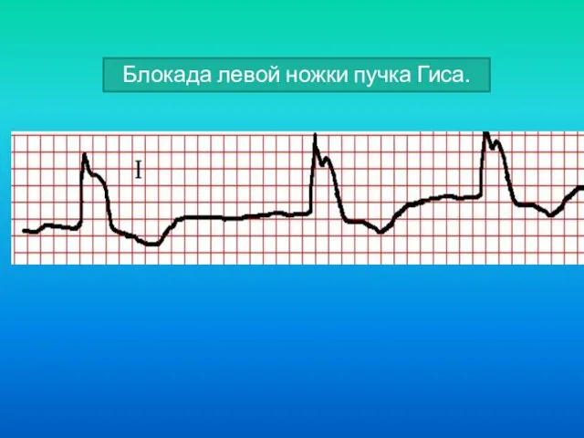 Блокада левой ножки пучка Гиса.