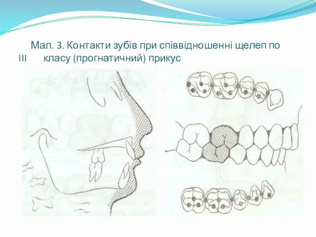 Мал. 3. Контакти зубів при співвідношенні щелеп по III класу (прогнатичний) прикус