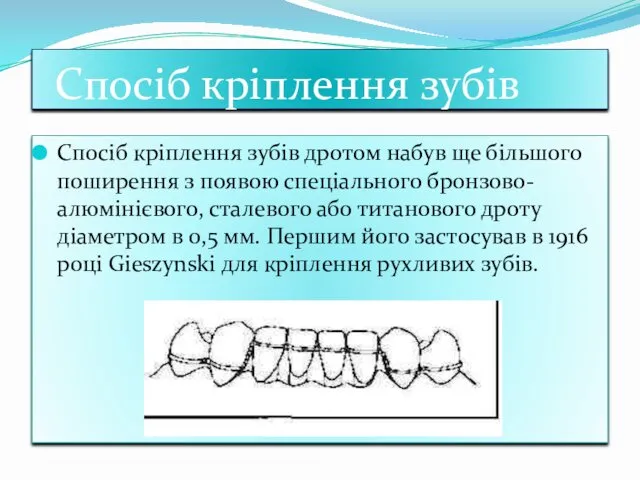 Спосiб крiплення зубiв Спосіб кріплення зубів дротом набув ще більшого