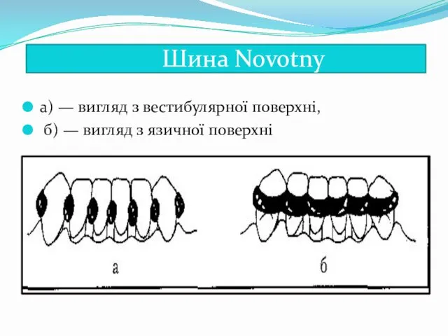 : Шина Novotny a) — вигляд з вестибулярної поверхні, б) — вигляд з язичної поверхні