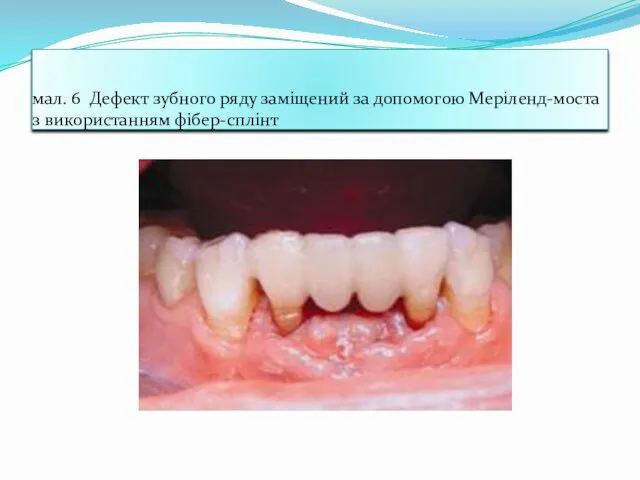 мал. 6 Дефект зубного ряду заміщений за допомогою Меріленд-моста з використанням фібер-сплінт