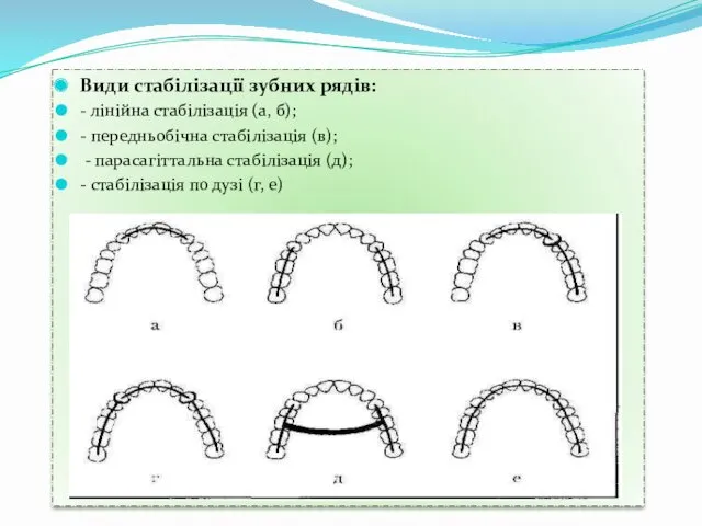 Види стабілізації зубних рядів: - лінійна стабілізація (а, б); -