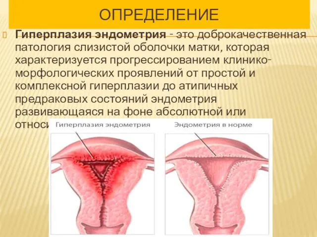 ОПРЕДЕЛЕНИЕ Гиперплазия эндометрия - это доброкачественная патология слизистой оболочки матки,