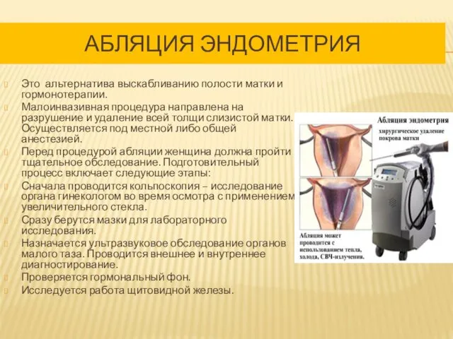 АБЛЯЦИЯ ЭНДОМЕТРИЯ Это альтернатива выскабливанию полости матки и гормонотерапии. Малоинвазивная