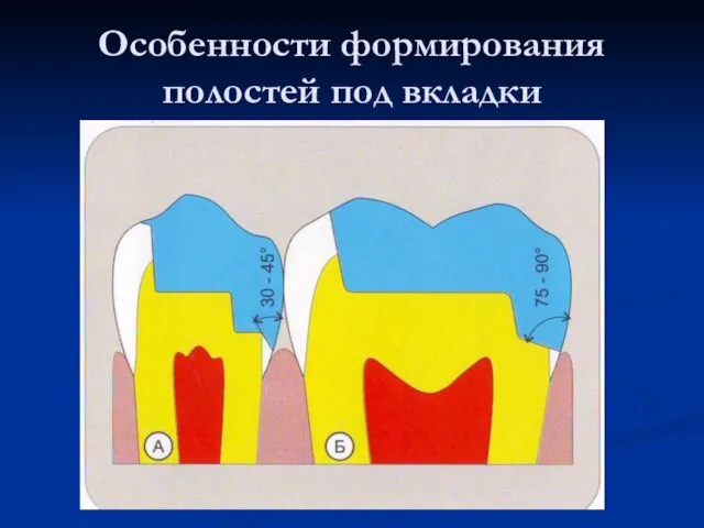 Особенности формирования полостей под вкладки