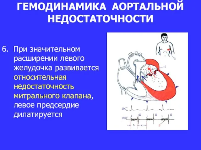 ГЕМОДИНАМИКА АОРТАЛЬНОЙ НЕДОСТАТОЧНОСТИ 6. При значительном расширении левого желудочка развивается