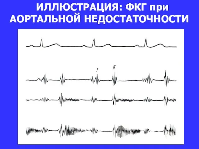 ИЛЛЮСТРАЦИЯ: ФКГ при АОРТАЛЬНОЙ НЕДОСТАТОЧНОСТИ