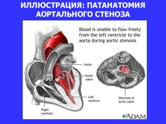 ИЛЛЮСТРАЦИЯ: ПАТАНАТОМИЯ АОРТАЛЬНОГО СТЕНОЗА