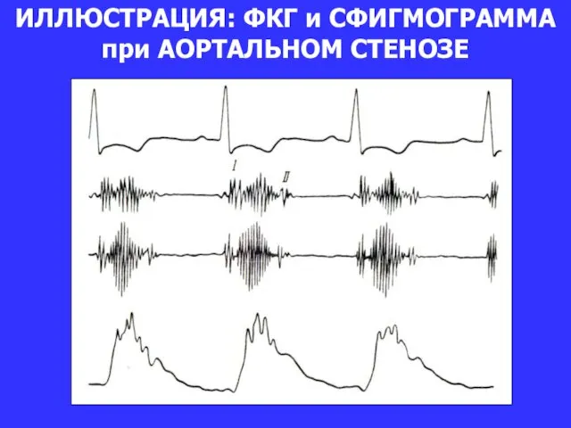 ИЛЛЮСТРАЦИЯ: ФКГ и СФИГМОГРАММА при АОРТАЛЬНОМ СТЕНОЗЕ