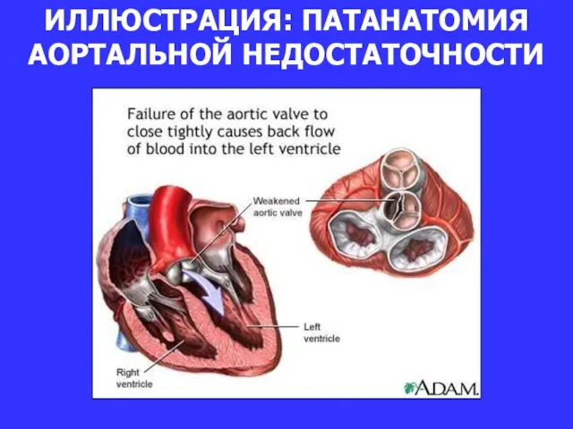 ИЛЛЮСТРАЦИЯ: ПАТАНАТОМИЯ АОРТАЛЬНОЙ НЕДОСТАТОЧНОСТИ