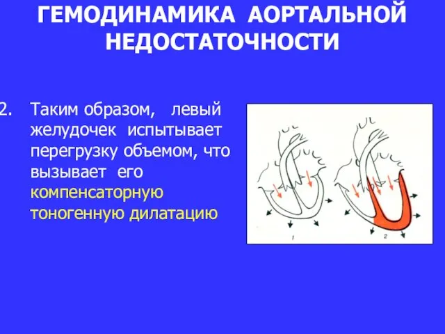 ГЕМОДИНАМИКА АОРТАЛЬНОЙ НЕДОСТАТОЧНОСТИ Таким образом, левый желудочек испытывает перегрузку объемом, что вызывает его компенсаторную тоногенную дилатацию