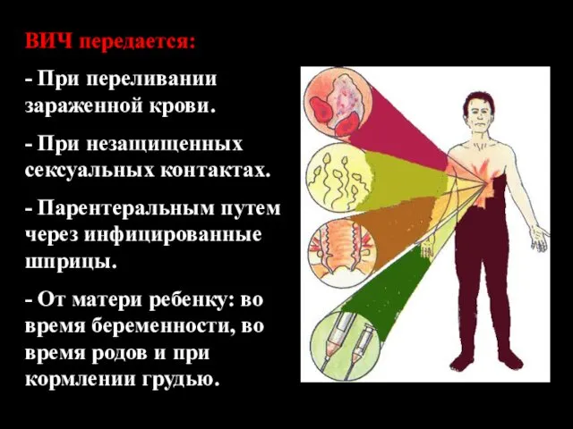 ВИЧ передается: - При переливании зараженной крови. - При незащищенных