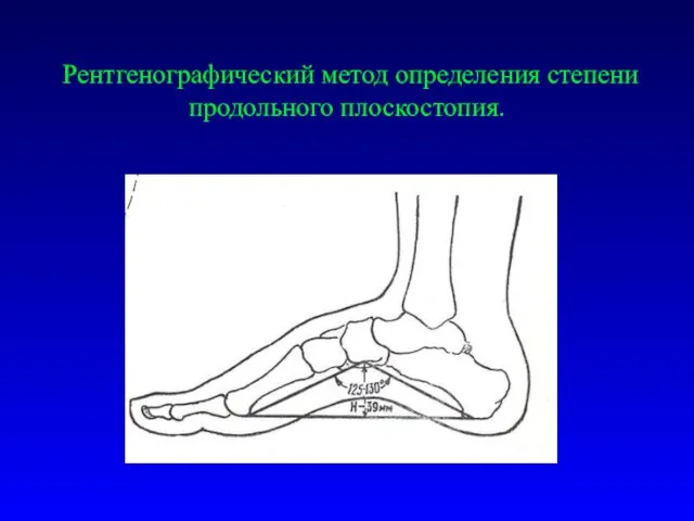 Рентгенографический метод определения степени продольного плоскостопия.