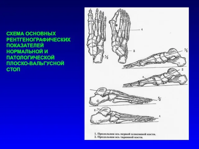 СХЕМА ОСНОВНЫХ РЕНТГЕНОГРАФИЧЕСКИХ ПОКАЗАТЕЛЕЙ НОРМАЛЬНОЙ И ПАТОЛОГИЧЕСКОЙ ПЛОСКО-ВАЛЬГУСНОЙ СТОП