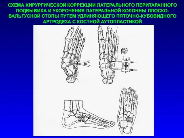 СХЕМА ХИРУРГИЧЕСКОЙ КОРРЕКЦИИ ЛАТЕРАЛЬНОГО ПЕРИТАРАННОГО ПОДВЫВИХА И УКОРОЧЕНИЯ ЛАТЕРАЛЬНОЙ КОЛОННЫ