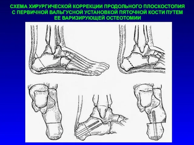 СХЕМА ХИРУРГИЧЕСКОЙ КОРРЕКЦИИ ПРОДОЛЬНОГО ПЛОСКОСТОПИЯ С ПЕРВИЧНОЙ ВАЛЬГУСНОЙ УСТАНОВКОЙ ПЯТОЧНОЙ КОСТИ ПУТЕМ ЕЕ ВАРИЗИРУЮЩЕЙ ОСТЕОТОМИИ