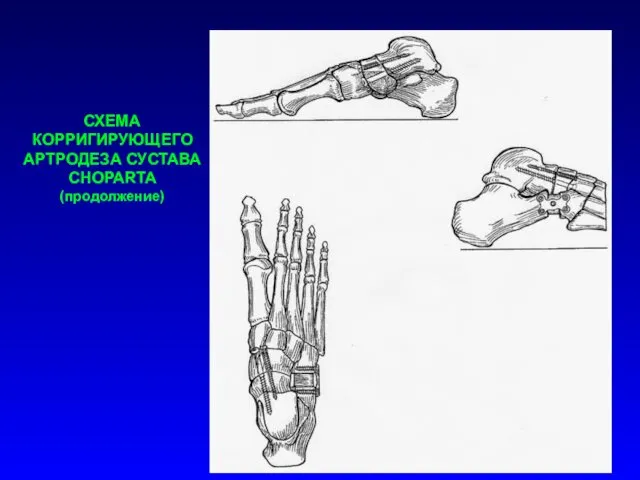 СХЕМА КОРРИГИРУЮЩЕГО АРТРОДЕЗА СУСТАВА CHOPARTA (продолжение)