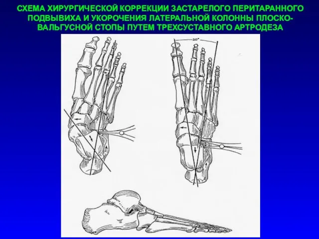 СХЕМА ХИРУРГИЧЕСКОЙ КОРРЕКЦИИ ЗАСТАРЕЛОГО ПЕРИТАРАННОГО ПОДВЫВИХА И УКОРОЧЕНИЯ ЛАТЕРАЛЬНОЙ КОЛОННЫ ПЛОСКО-ВАЛЬГУСНОЙ СТОПЫ ПУТЕМ ТРЕХСУСТАВНОГО АРТРОДЕЗА