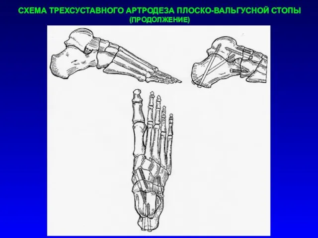 СХЕМА ТРЕХСУСТАВНОГО АРТРОДЕЗА ПЛОСКО-ВАЛЬГУСНОЙ СТОПЫ (ПРОДОЛЖЕНИЕ)