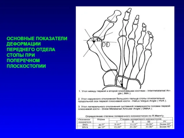 ОСНОВНЫЕ ПОКАЗАТЕЛИ ДЕФОРМАЦИИ ПЕРЕДНЕГО ОТДЕЛА СТОПЫ ПРИ ПОПЕРЕЧНОМ ПЛОСКОСТОПИИ